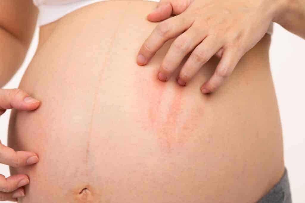 Unreine Haut Schwangerschaft